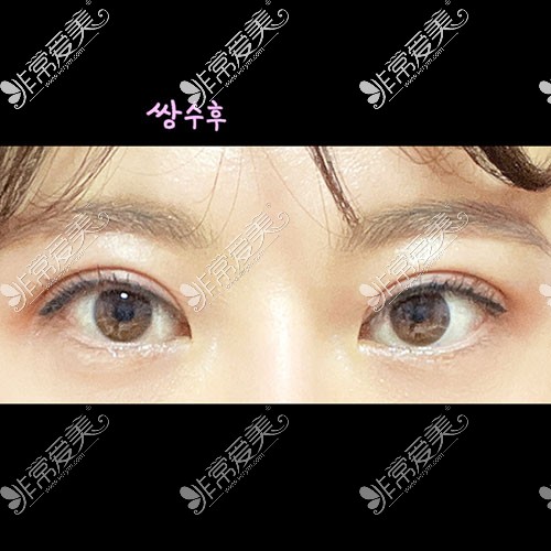 韩国icon双眼皮整形睁眼照片