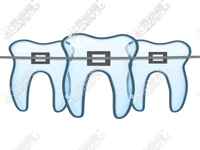 牙齿正畸上牙套示意图