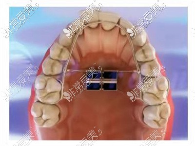 正畸佩戴矫治器阶段
