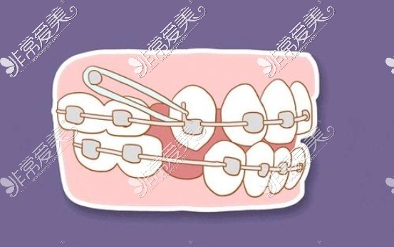 正畸支抗钉为牙齿移动施力过程