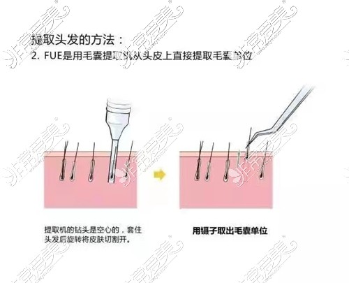 FUE植发技术方法解释