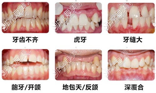 需要矫正的几种牙齿形态