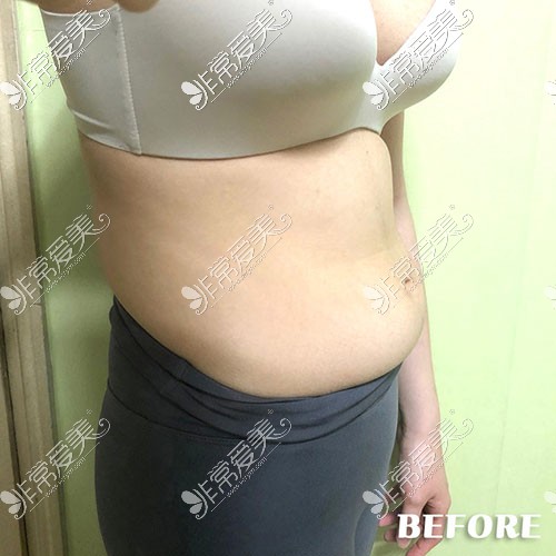 韩国丽迪安整形腰腹吸脂术前照片
