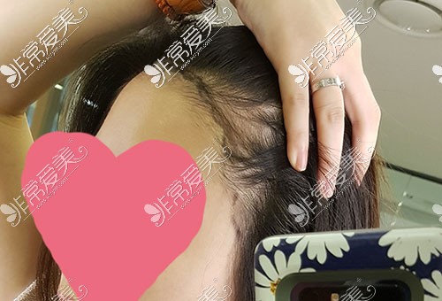 韩国黄盛柱女性发际线脱发照片