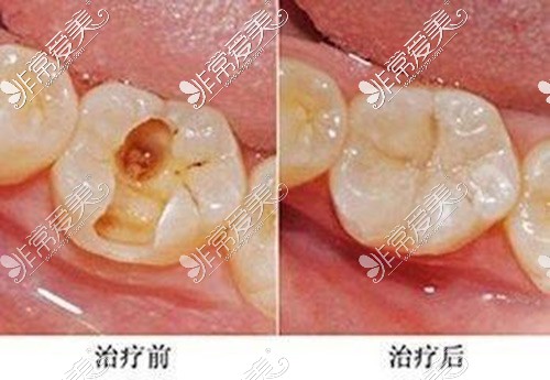 牙齿龋坏诊疗前和诊疗后