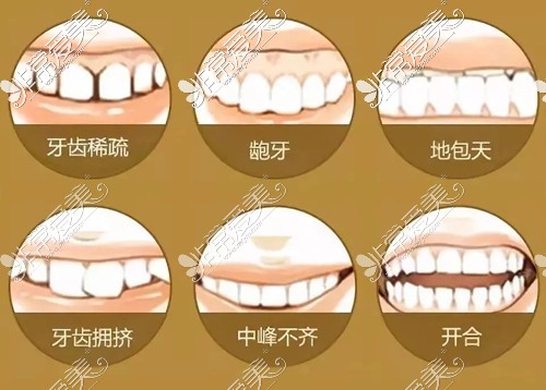 哪些牙齿问题需要做矫正