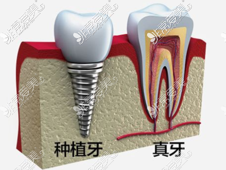 种植体品牌排名全系列名单，哪款适合自己一看就知道！