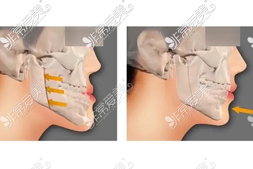 双鄂手术示意图