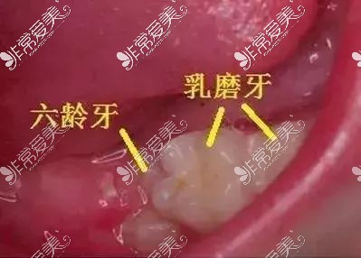 六龄牙示意图