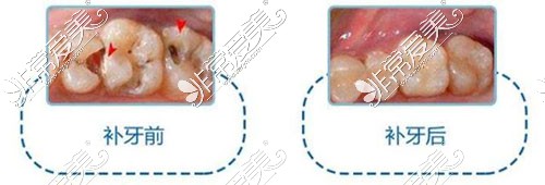 补牙前后
