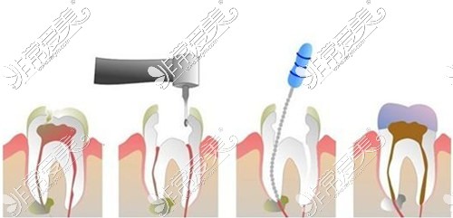 根管治疗示意图