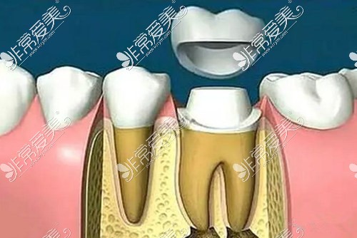 根管治療后佩戴牙冠
