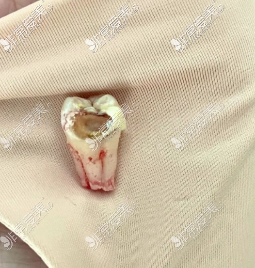 被智齿顶坏的牙齿图片图片