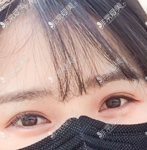 韩国yellow双眼皮整形30天