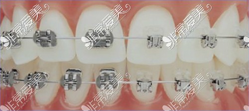 金属牙套和陶瓷自锁牙套对比