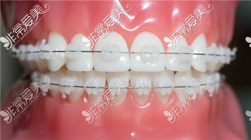 元半隐形牙套常见采用的是陶瓷,水晶,单晶这类颜色度偏透明的托槽
