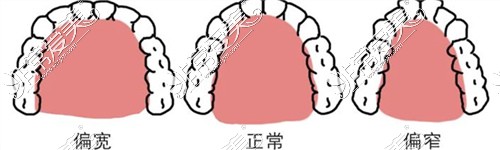 牙弓對(duì)比