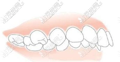 深覆合牙齿矫正展示图