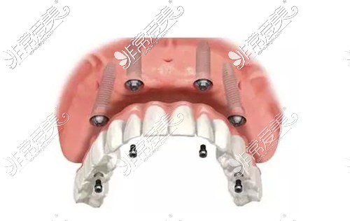 all-on-4種植技術(shù)