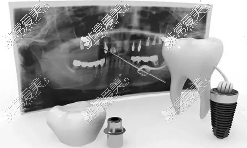 种植牙图片