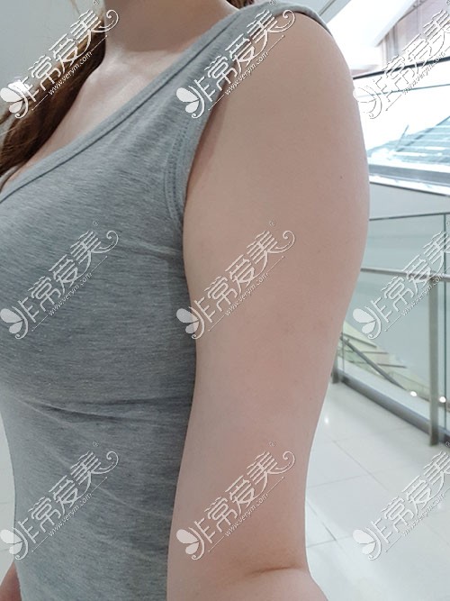 韩国芙莱思手臂吸脂照片