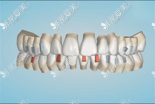 正畸期间牙齿排齐阶段