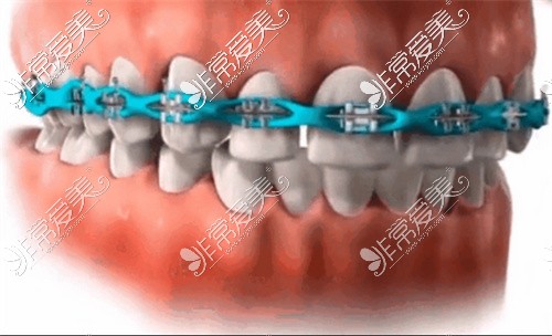 隐形牙套收牙缝过程图图片