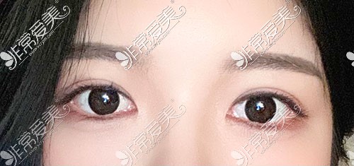韩国yellow整形双眼皮术后30天