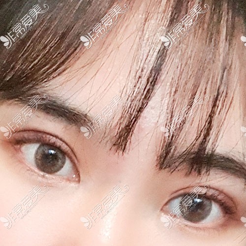 韩国双眼皮整形照片