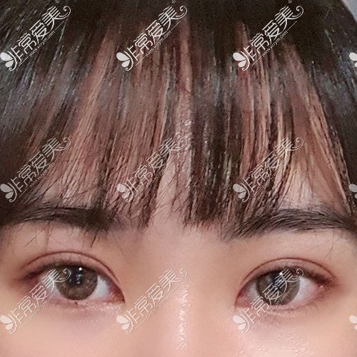 韩国yellow双眼皮手术图片