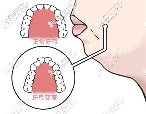 正常牙弓与牙弓变窄对比图