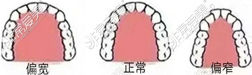 各种牙弓类型