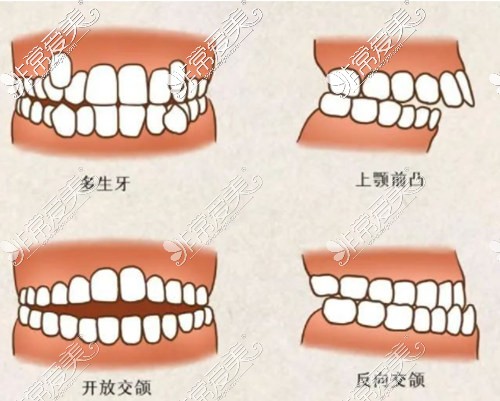 牙齿错颌类型