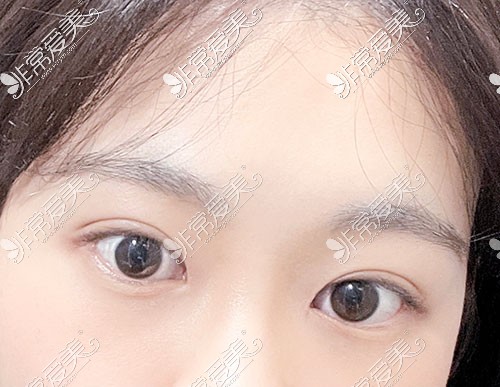韩国yellow双眼皮术后素颜照