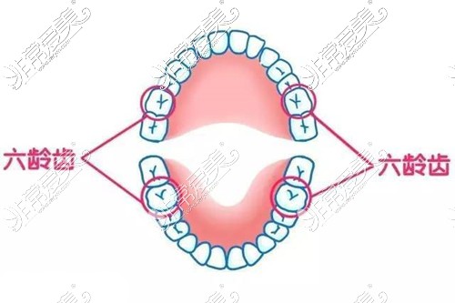 父母必须掌握的儿童蛀牙知识之六龄齿