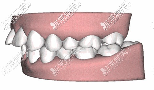 龅牙示意图
