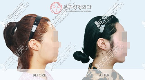 韩国BornDi下颌角手术侧面照片