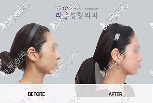 韩国BornDi下颌角手术对比图