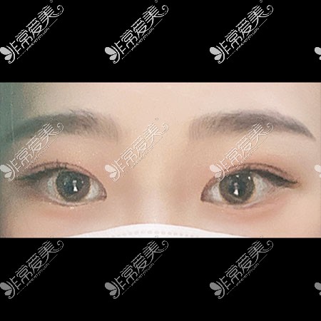 韩国icon双眼皮术后图片