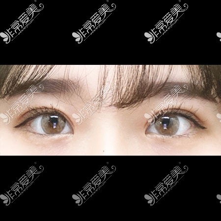 韩国icon双眼皮整形图片