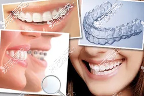 牙齿矫正的几种方式展示图