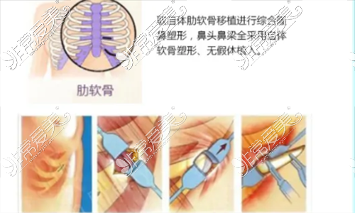 肋软骨隆鼻示意图