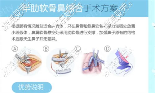 半肋軟骨隆鼻手術(shù)方案