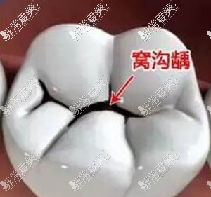 窩溝齲壞照片