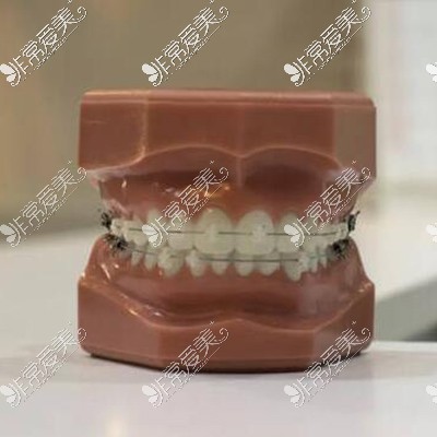 陶瓷半隐形牙齿矫正材料