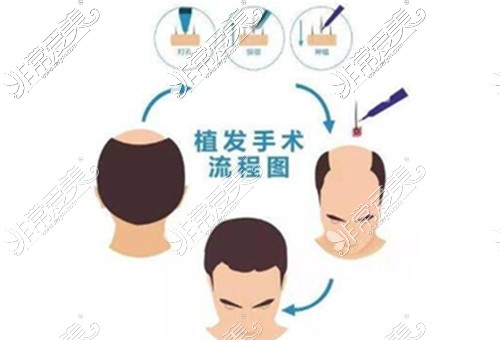 遵义植发医院哪家比较好？治疗脱发去哪家整形医院好呢？