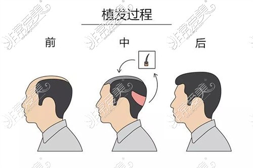 四川遂宁艾韩阳光医疗美容门诊部植发过程