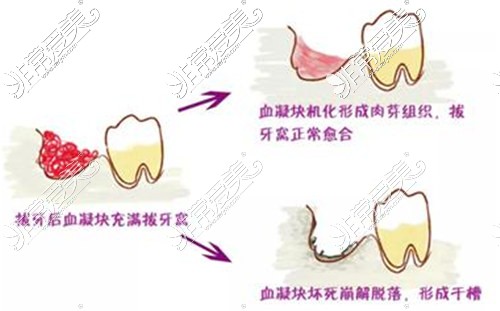 干槽症牙槽窝内出现灰白色凝血块