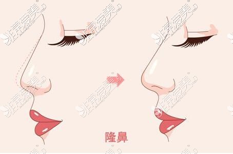 鼻部整形前后对比图 鼻部整形前后对比图