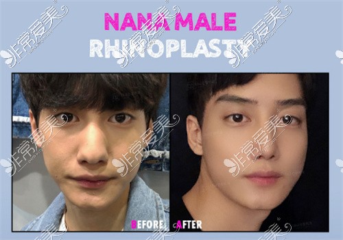 韩国NANA整形外科男士鼻整形前后图
